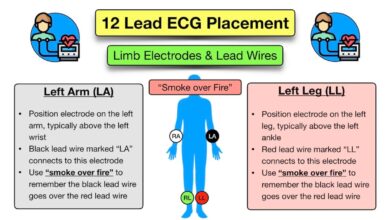 leads on ecg